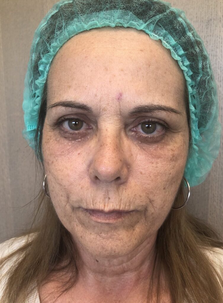 Lifting médical, après la pose de fils tenseurs Lifting médical, après la pose de fils tenseurs