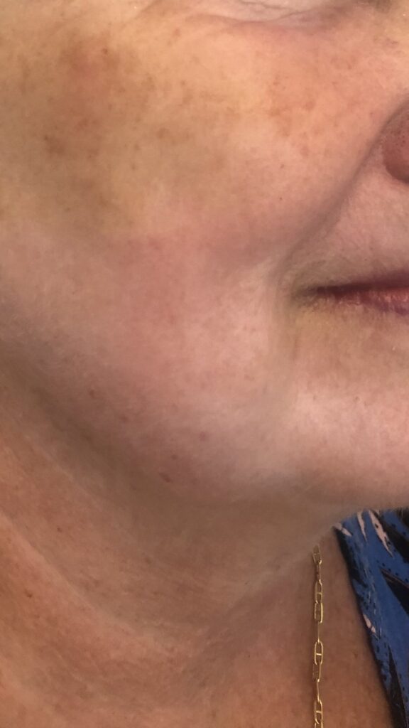 Peeling, après le soin Peeling, après le soin