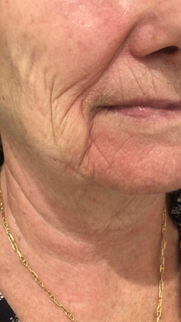 Peeling, avant le soin Peeling, avant le soin